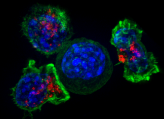 Immune cells surround a cancer cell.