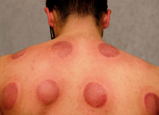 Characteristic round bruising from cupping therapy to ease muscle pain