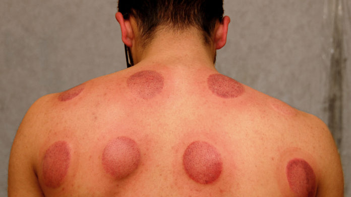 Characteristic round bruising from cupping therapy to ease muscle pain