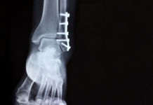 Metallic implant in leg x-ray
