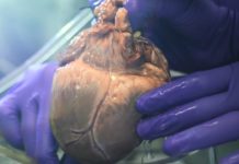 Heart operation