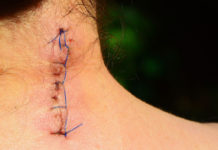 scar on neck