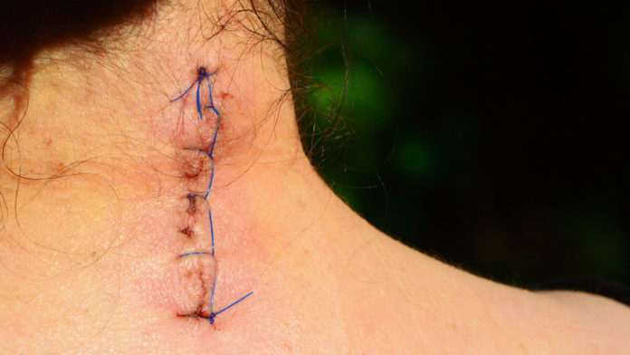 scar on neck